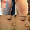 Laser Tattoo Removal Cost 532nm 755nm 1064nm Nd Yag